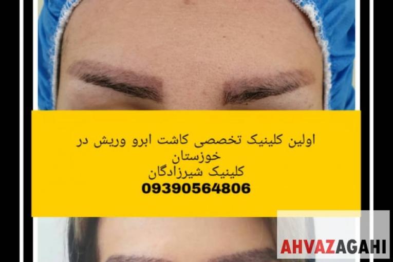 کاشت مو و ابرو ریش و سبیل در کلینیک شیرزادگان 