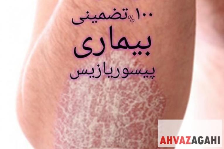 بهبود و درمان بدون بازگشت بیماری صدف ( پسوریازیس)